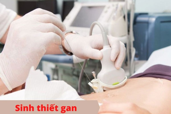 Sinh thiết gan kiểm tra tình trạng nhiễm độc gan